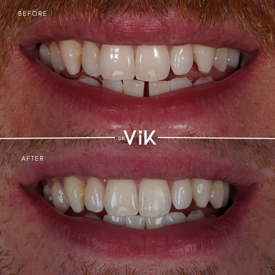 Invisalign case 5