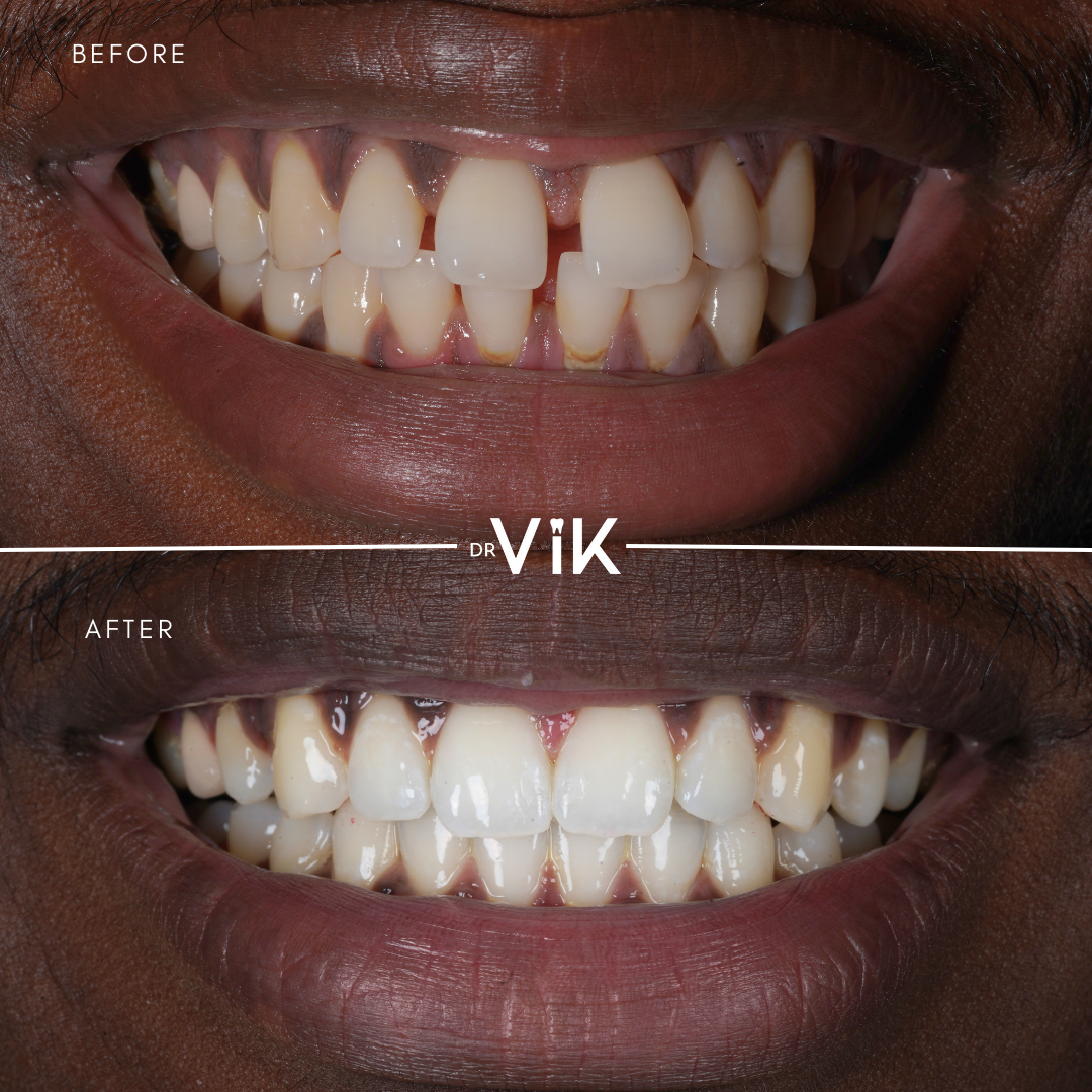 Invisalign case 7