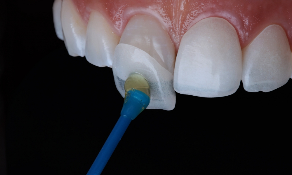 Porcelain restorations with Dr. Vik