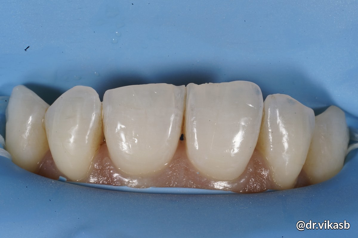 Isolation with rubber dam