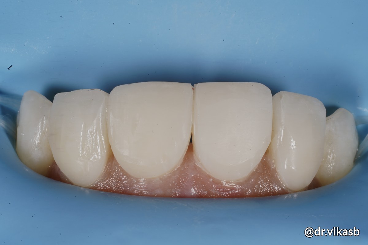 Layering and polishing
