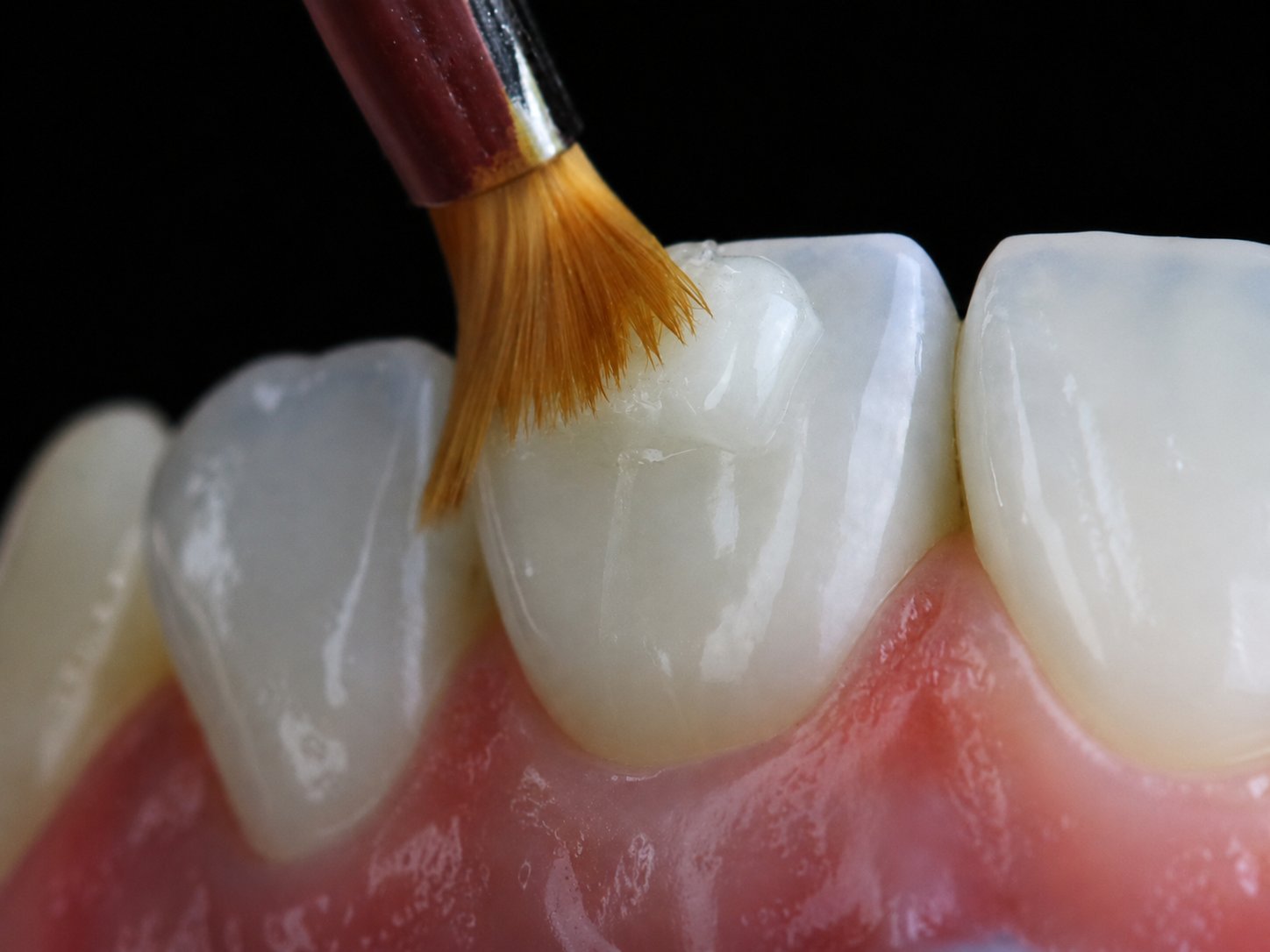 Composite bonding with Dr. Vik