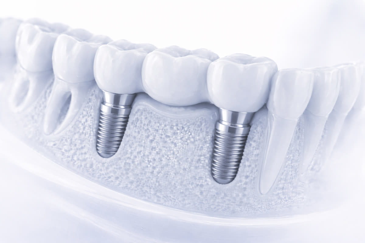 Implant-supported bridge — two implants spanning multiple missing teeth