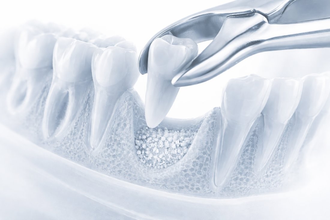 Extraction and bone graft
