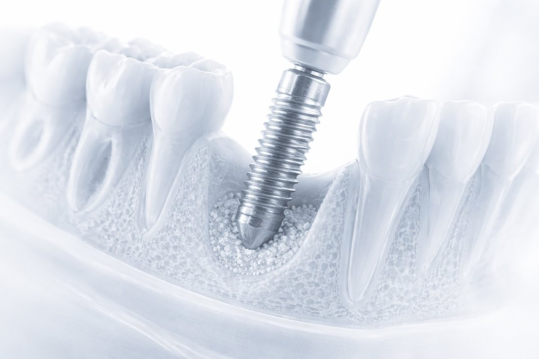 Implant placement