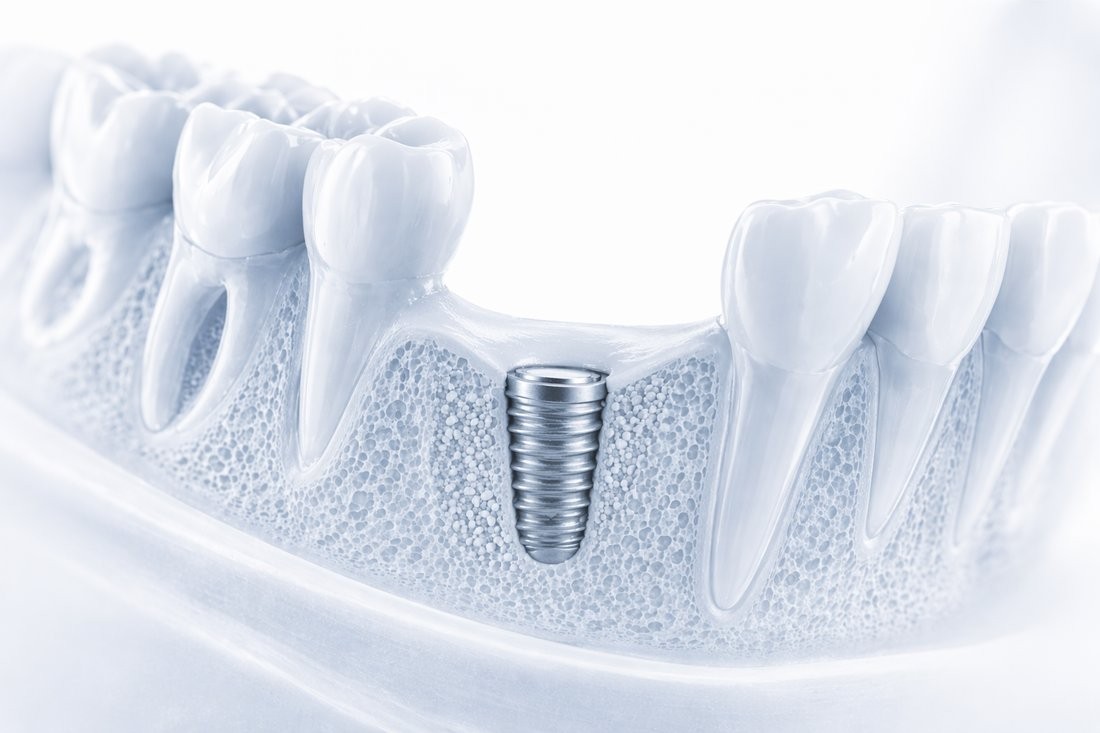 Osseointegration