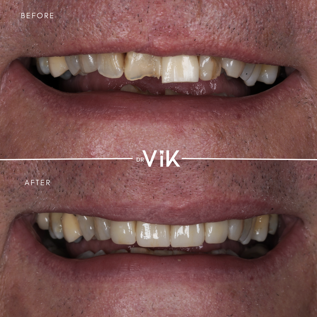 Porcelain veneers case