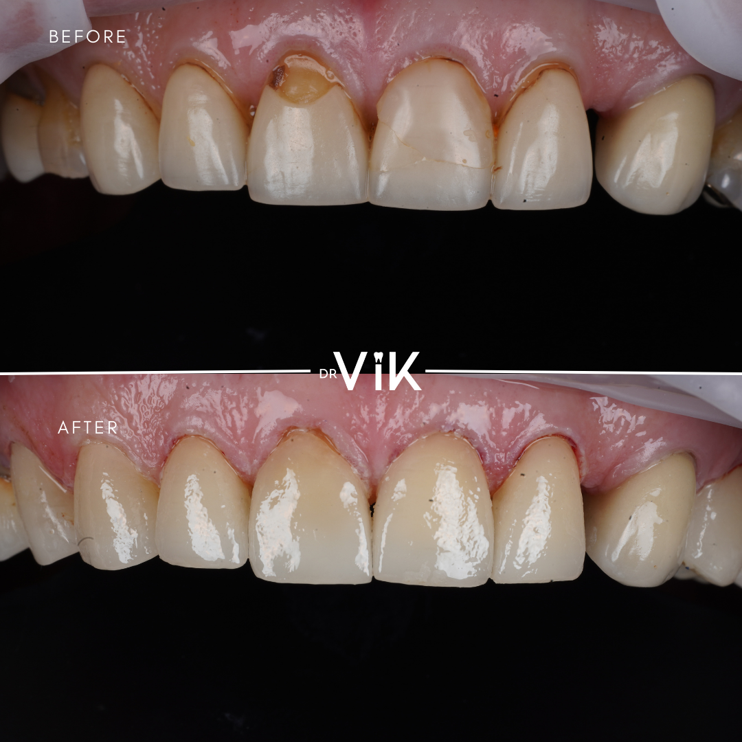 Porcelain makeover case
