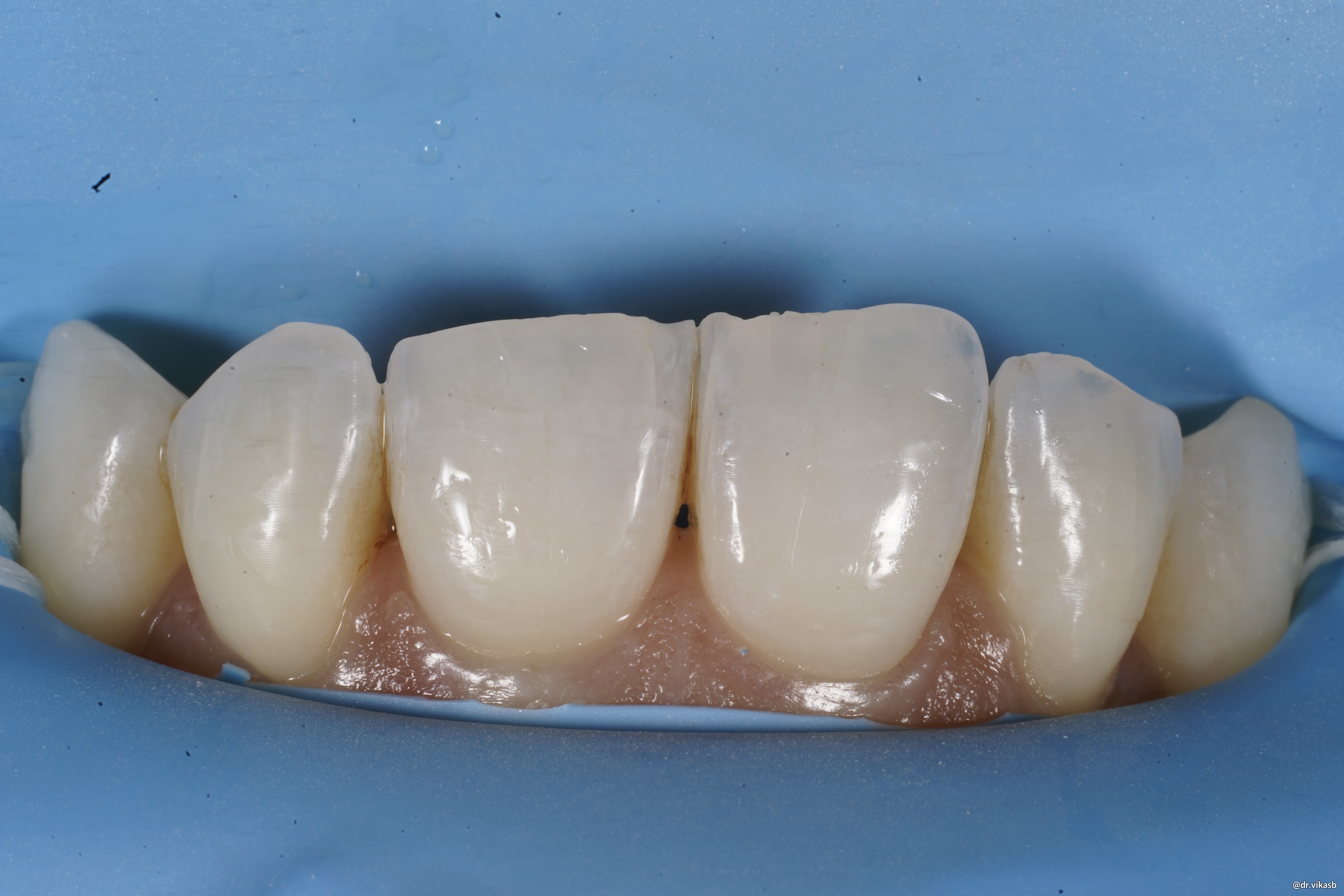 Isolation with rubber dam